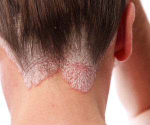 psoriasis on the hairline and on the scalp